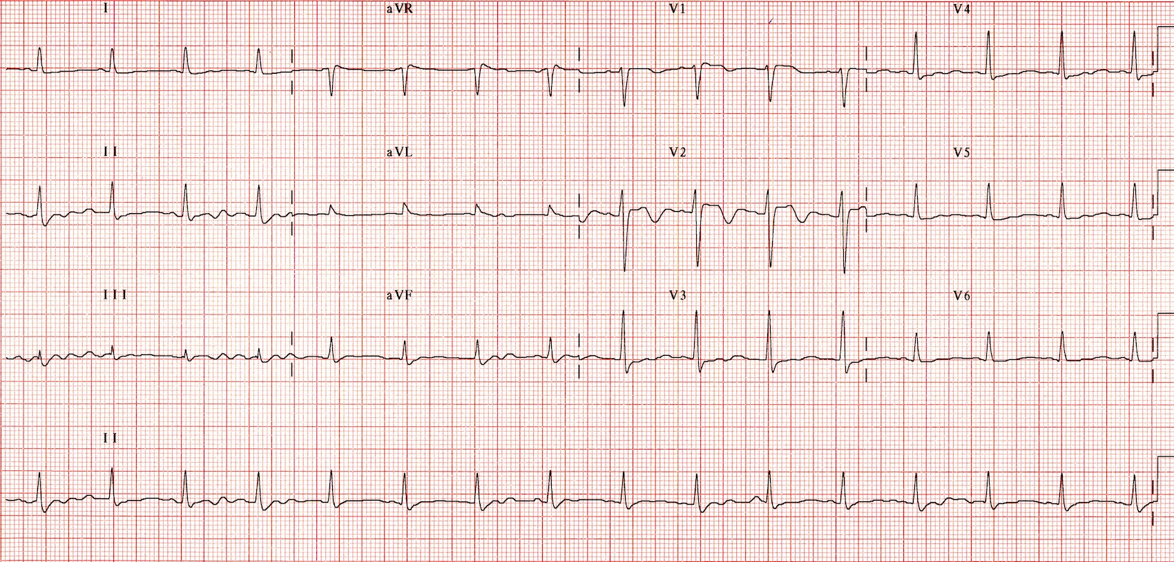 Kaynak : lifeinthefastlane.com - ECG library