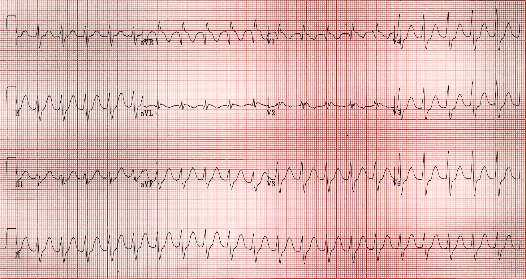 Kaynak : lifeinthefastlane.com - ECG library