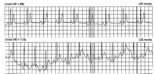 68 ve 119 vuru/dakika kalp hızlarında SQTS olan hastaya ait holter ritmi. 280 ms'lik QT aralığı her iki kalp hızında da sabit kalmaktadır (short QT syndrome.org'dan alınmıştır).