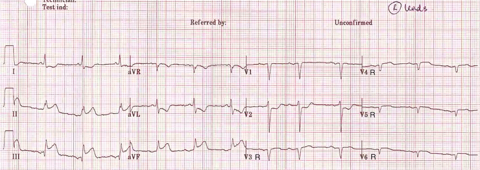 Kaynak : lifeinthefastlane.com - ECG library