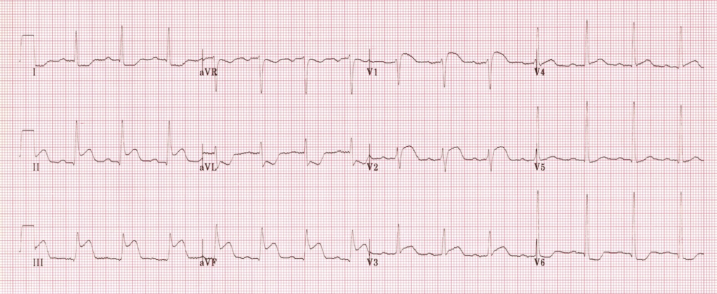 Kaynak : lifeinthefastlane.com - ECG library