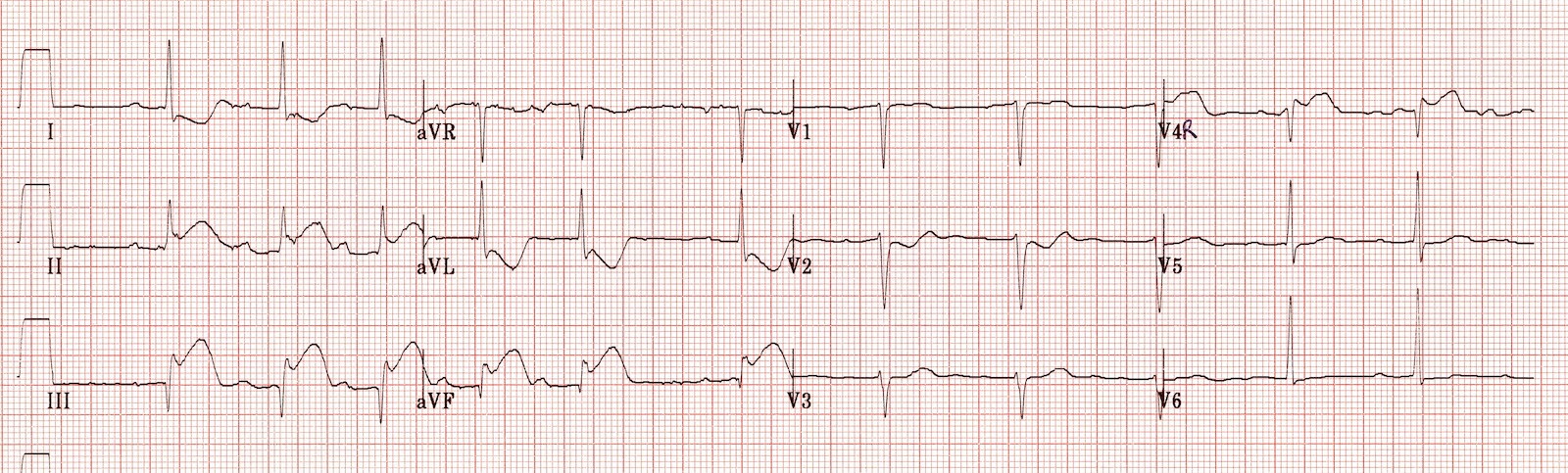 Kaynak : lifeinthefastlane.com - ECG library