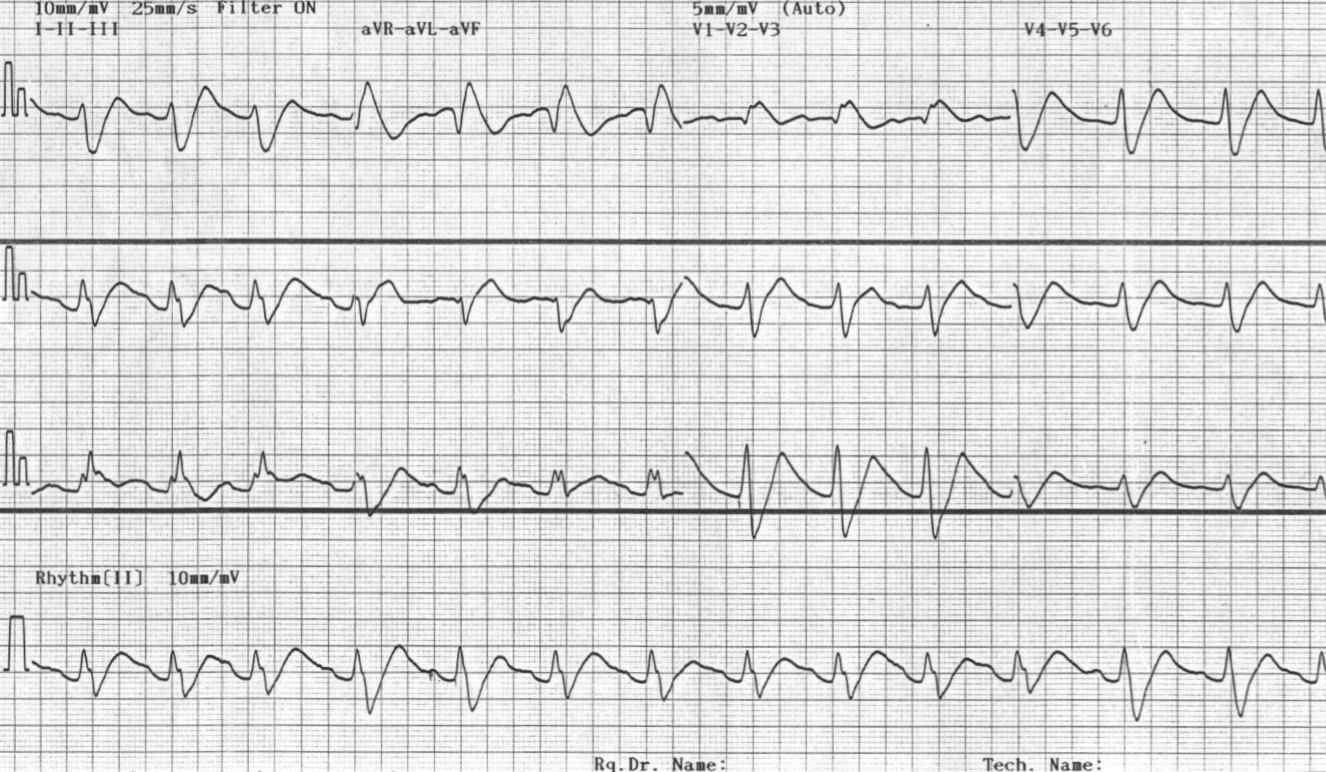 Kaynak : lifeinthefastlane.com - ECG library