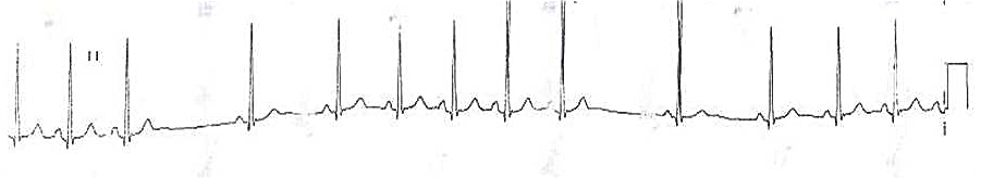Kaynak : lifeinthefastlane.com - ECG library