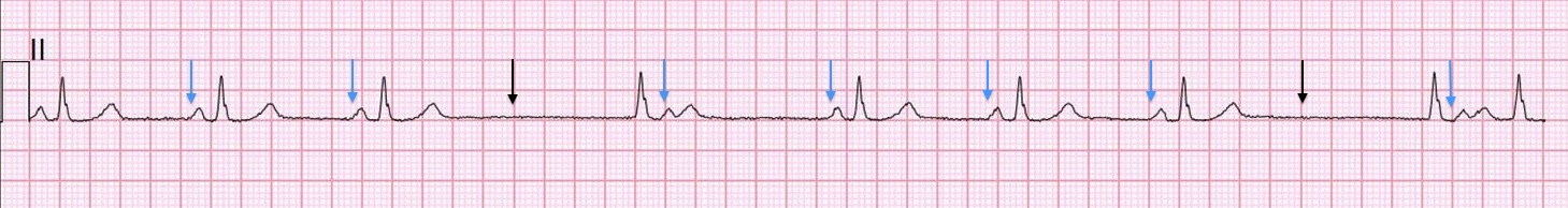 Kaynak : lifeinthefastlane.com - ECG library