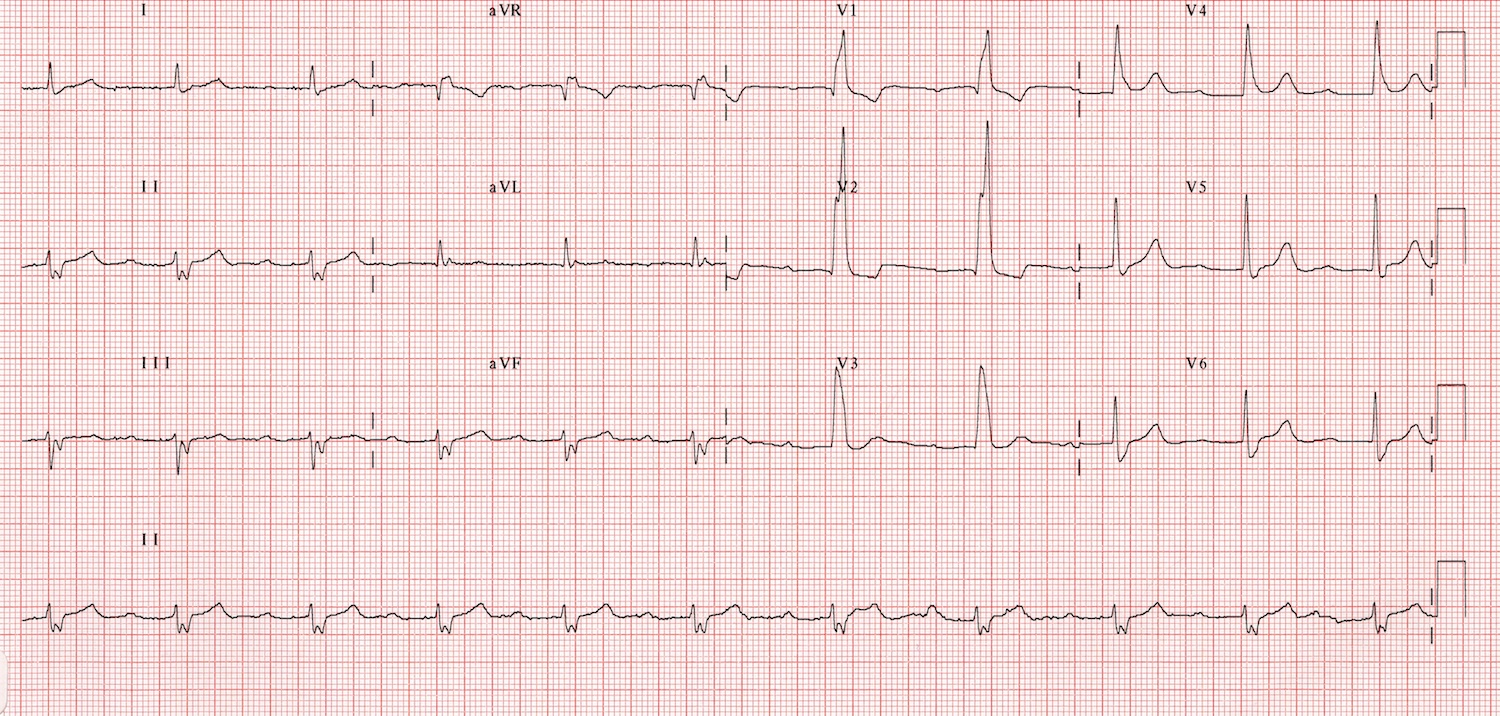 Kaynak : lifeinthefastlane.com - ECG library