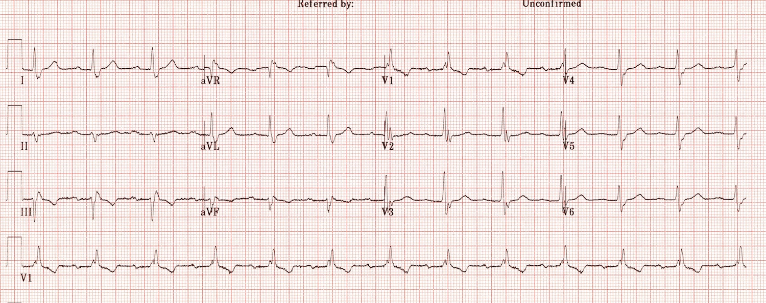 Kaynak : lifeinthefastlane.com - ECG library
