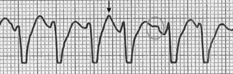AV disosiasyon : P dalgaları QRS kompleksleri arasında gösterilebilmektedir (daire) ve T dalgası ile üstüste gelip sivrileşmiş görünüme neden olmaktadır(ok). Kaynak : lifeinthefastlane.com - ECG library
