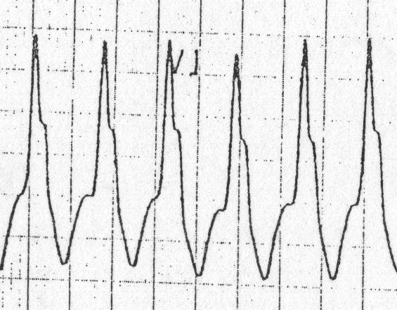 Solu daha uzun tavşan kulağı -> VT Kaynak : lifeinthefastlane.com - ECG library