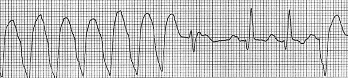 Füzyon vuruları : dar komplekslerden ilki füzyon vurusudur (sonraki ikisi yakalama vurusudur). Kaynak : lifeinthefastlane.com - ECG library