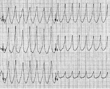 Prekordiyal derivasyonlarda pozitif konkordans Kaynak : lifeinthefastlane.com - ECG library