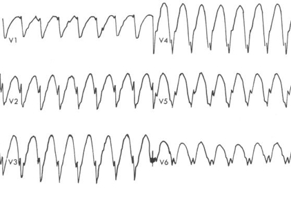 Sadece prekordiyal S dalgaları -> VT Kaynak : lifeinthefastlane.com ECG library