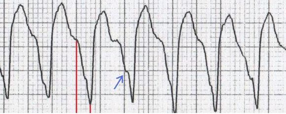 Brugada işareti (kırmızı çizgiler) ve Josephson işareti (mavi ok) Kaynak : lifeinthefastlane.com - ECG library