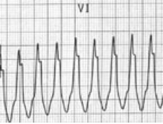 VT'de solu daha uzun tavşan kulağı Kaynak : lifeinthefastlane.com - ECG library