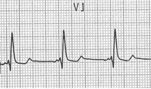 Sağ dal bloğunda sağı daha uzun tavşan kulağı Kaynak : lifeinthefastlane.com - ECG library