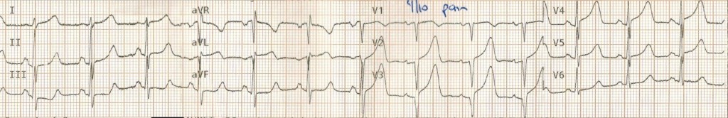 Wellens Sendromu 11 Kaynak : lifeinthefastlane.com - ECG library