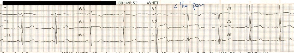 Wellens Sendromu 12 Kaynak : lifeinthefastlane.com - ECG library