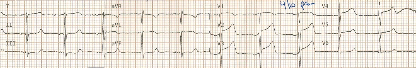 Wellens Sendromu 13 Kaynak : lifeinthefastlane.com - ECG library
