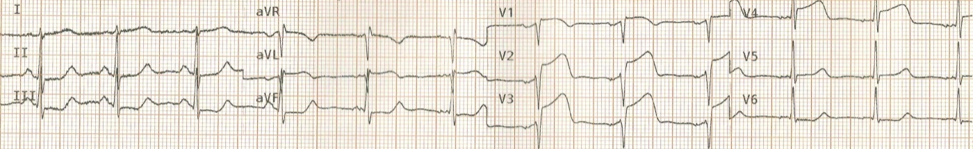 Wellens Sendromu 14 Kaynak : lifeinthefastlane.com - ECG library