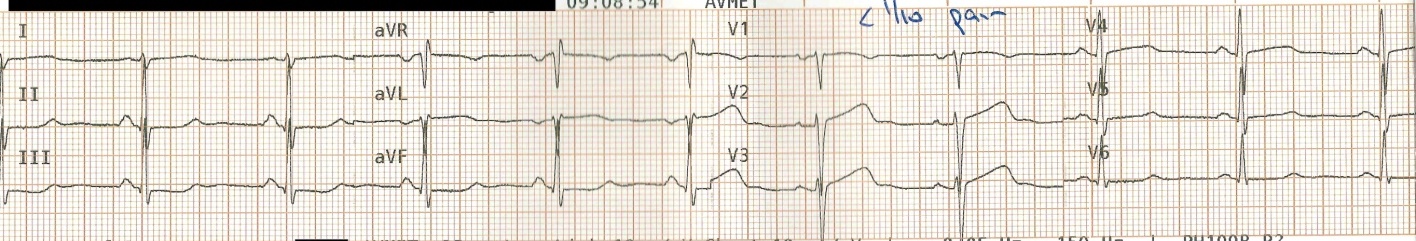 Wellens Sendromu 15 Kaynak : lifeinthefastlane.com - ECG library
