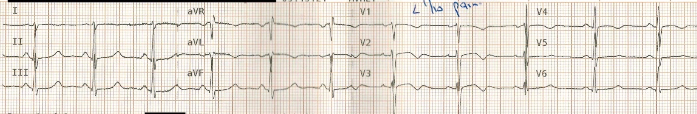 Wellens Sendromu 16 Kaynak : lifeinthefastlane.com - ECG library