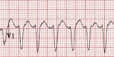 Sol dal bloğu benzeri morfoloji Kaynak : lifeinthefastlane.com - ECG library