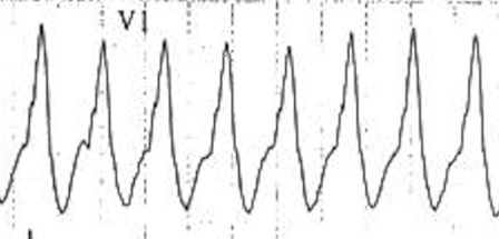 Yumuşak monofazik R dalgası -> VT KKaynak : lifeinthefastlane.com - ECG library