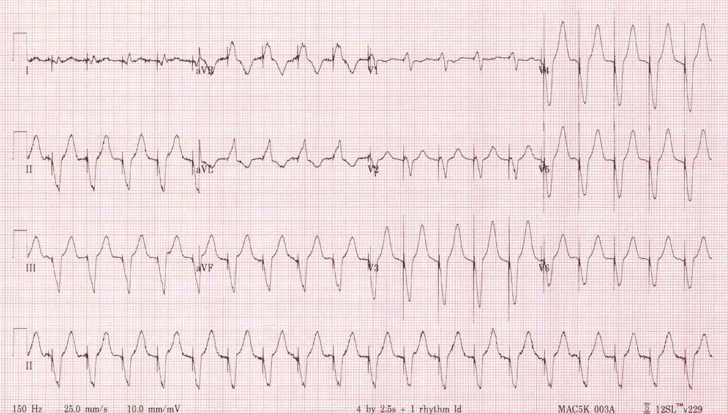 Kaynak : lifeinthefastlane.com - ECG library