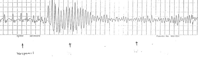 Kaynak : lifeinthefastlane.com - ECG library