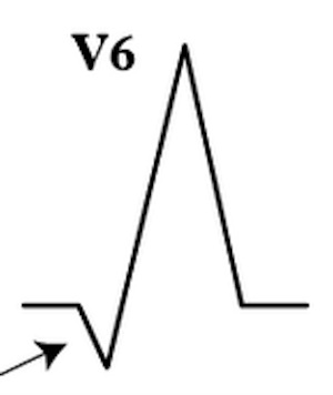 V6'da qR kompleksi -> VT