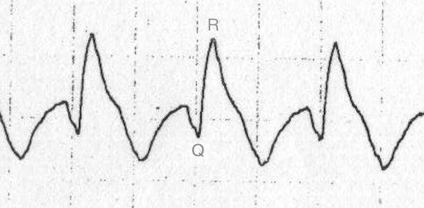 qR patterni -> VT Kaynak : lifeinthefastlane.com - ECG library