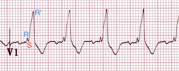 Sağ dal bloğunda tipik RSR' patterni Kaynak : lifeinthefastlane.com - ECG library