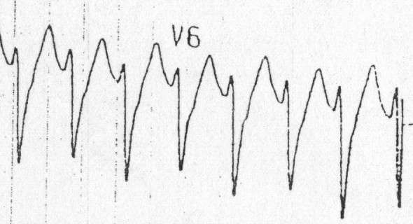 V6'da R/S oranı muhtemel VT Kaynak : lifeinthefastlane.com - ECG library