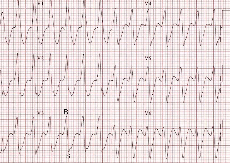 RS kompleksleri mevcut -> 2. adıma ilerleyin. Kaynak : lifeinthefastlane.com - ECG library