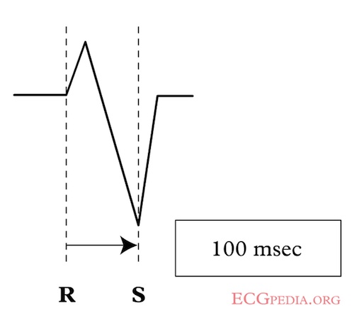 RS-interval