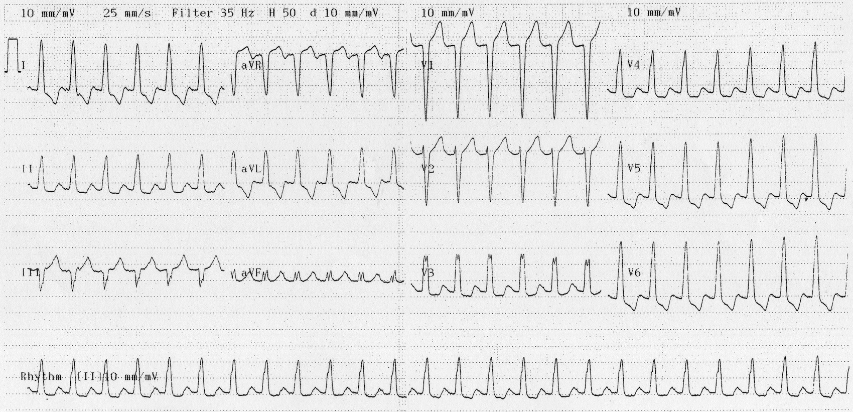 Kaynak : lifeinthefastlane.com - ECG library