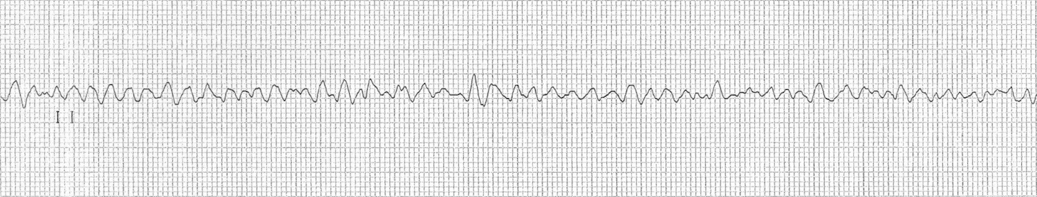 Kaynak : lifeinthefastlane.com - ECG library