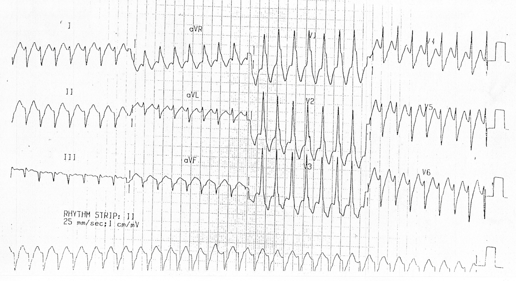 Kaynak : lifeinthefastlane.com - ECG library