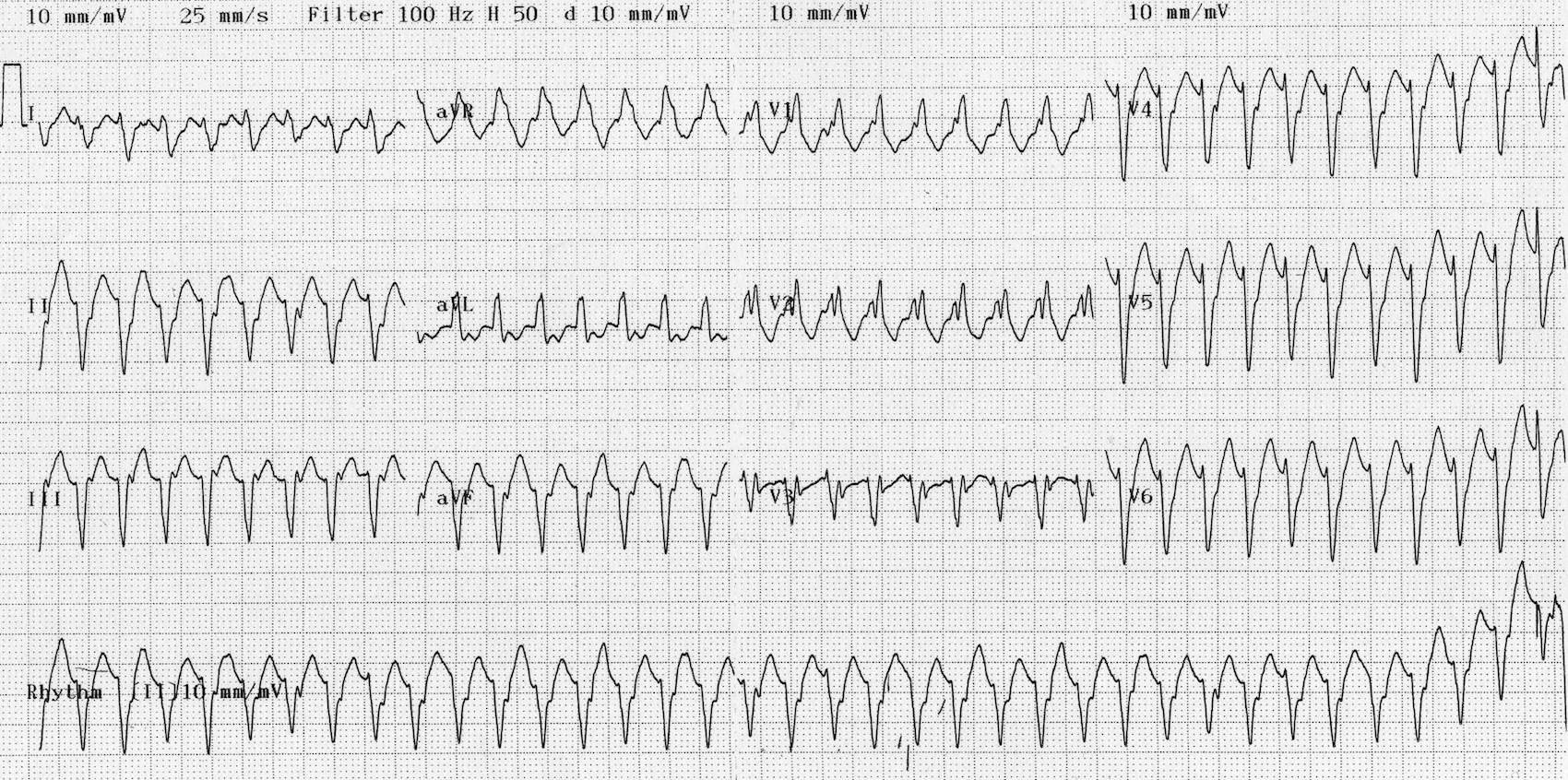 Kaynak : lifeinthefastlane.com - ECG library