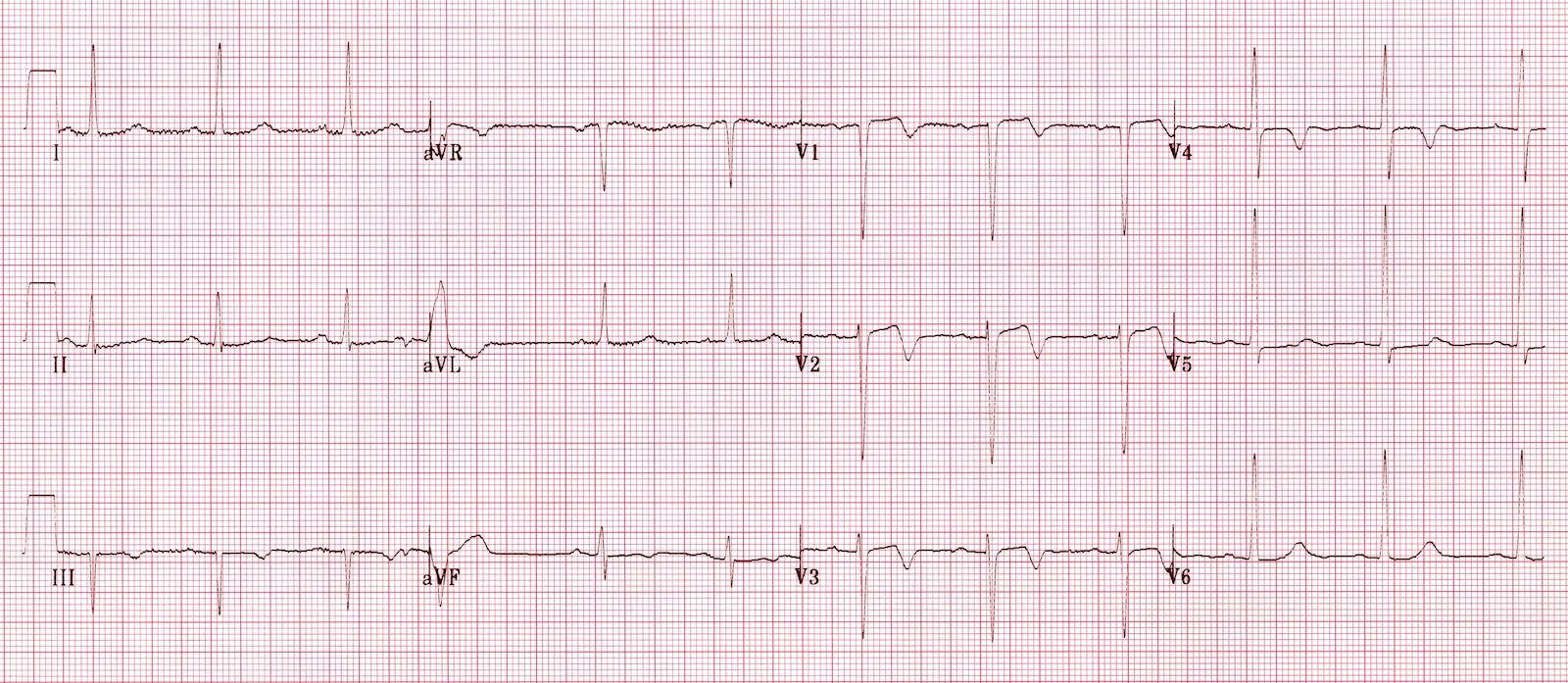Wellens Sendromu 7 Kaynak : lifeinthefastlane.com - ECG library