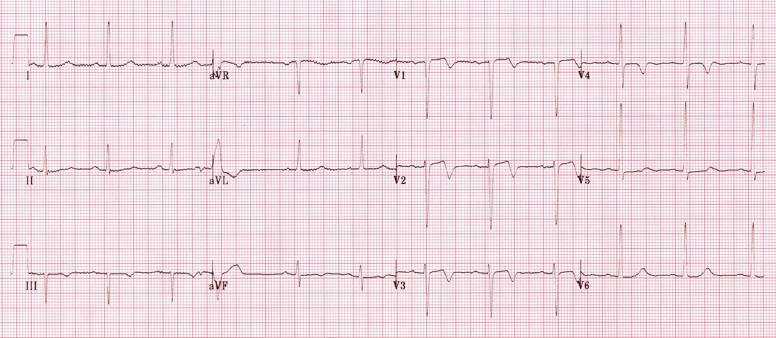 Kaynak : lifeinthefastlane.com - ECG library