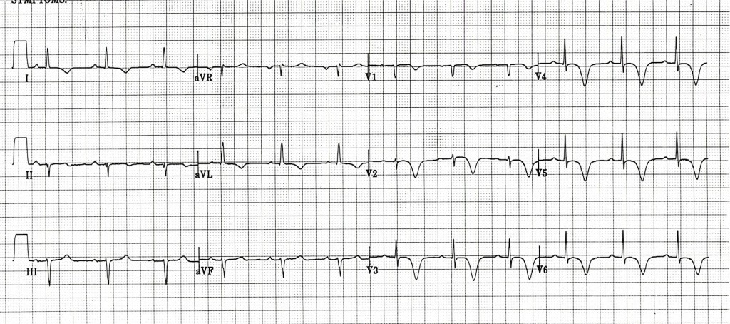 Wellens Sendromu 8 Kaynak : lifeinthefastlane.com - ECG library