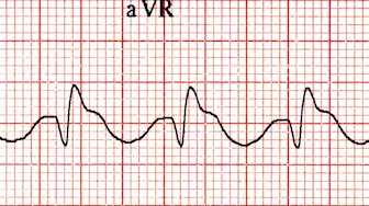 aVR'de dominant ikincil R' dalgası -> TCA zehirlenmesi Kaynak : lifeinthefastlane.com - ECG library