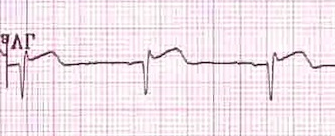 Kaynak : lifeinthefastlane.com - ECG library