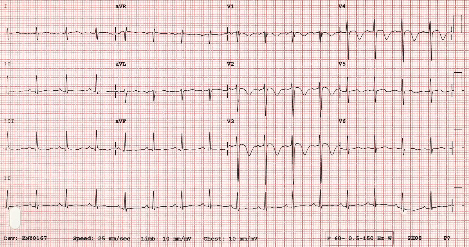 Wellens Sendromu 17 Kaynak : lifeinthefastlane.com - ECG library