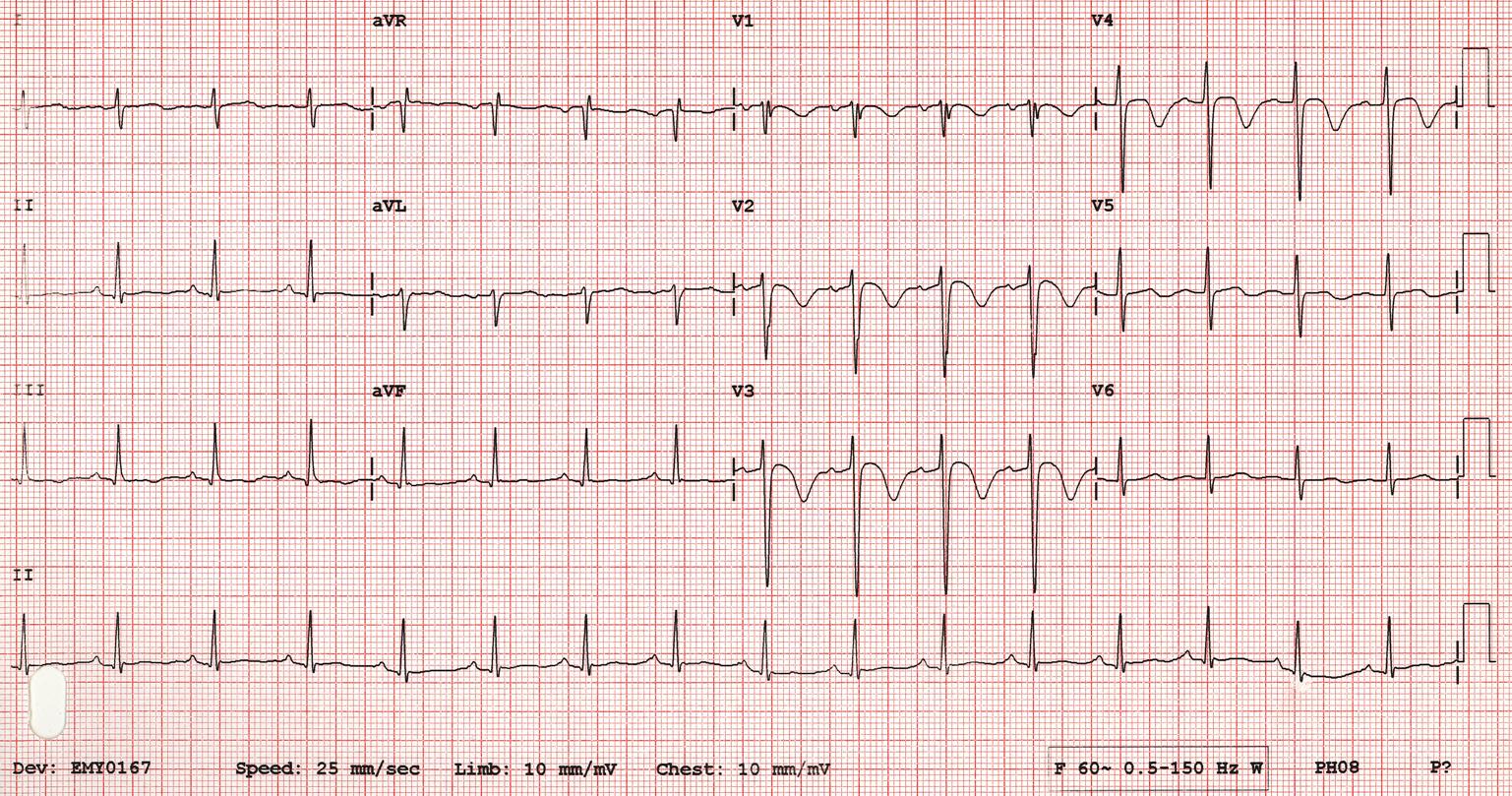 Kaynak : lifeinthefastlane.com - ECG library