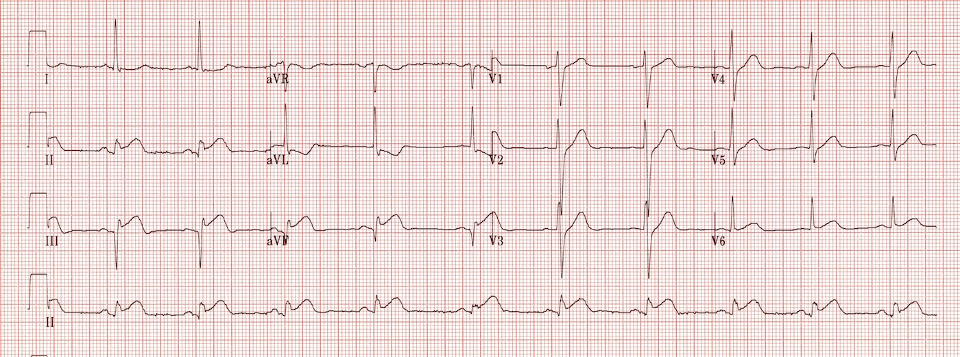 Kaynak : lifeinthefastlane.com - ECG library
