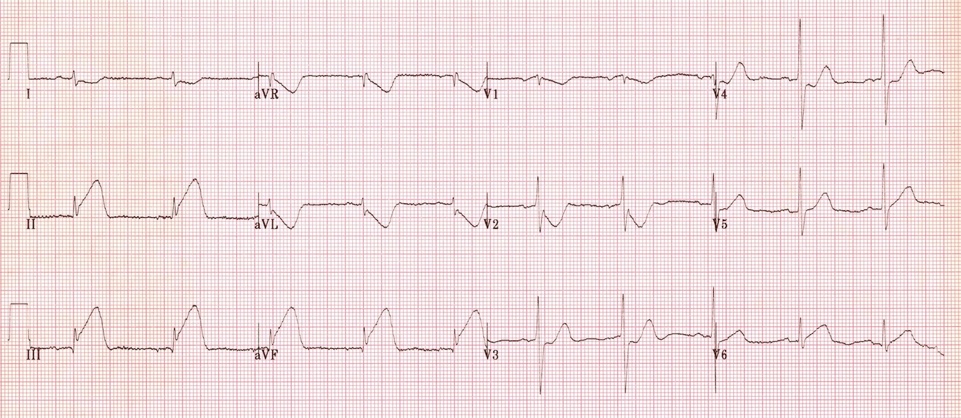 Kaynak : lifeinthefastlane.com - ECG library