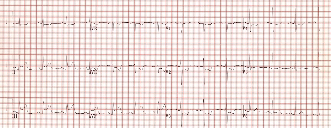 Kaynak : lifeinthefastlane.com - ECG library