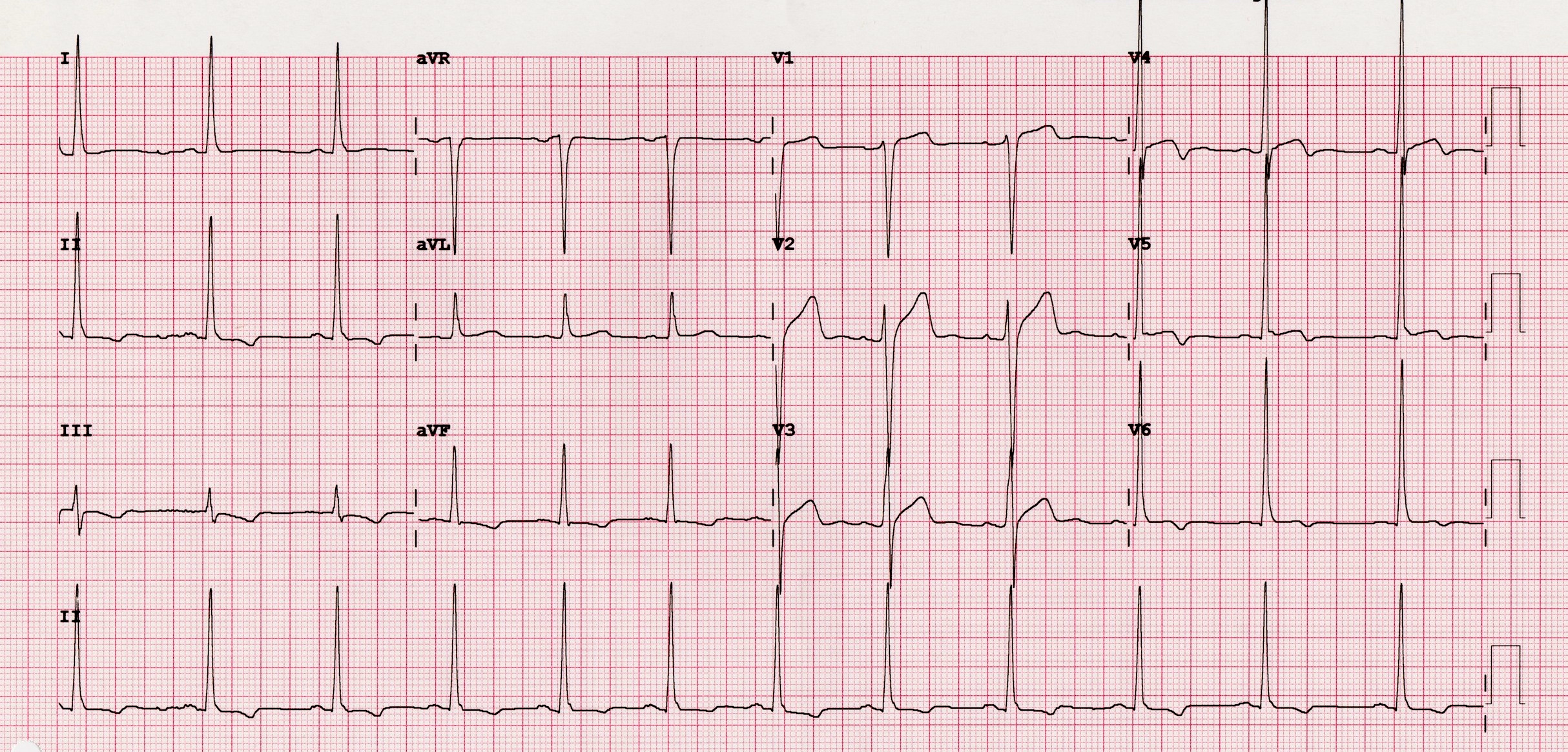 Wellens Sendromu 18 Kaynak : lifeinthefastlane.com - ECG library